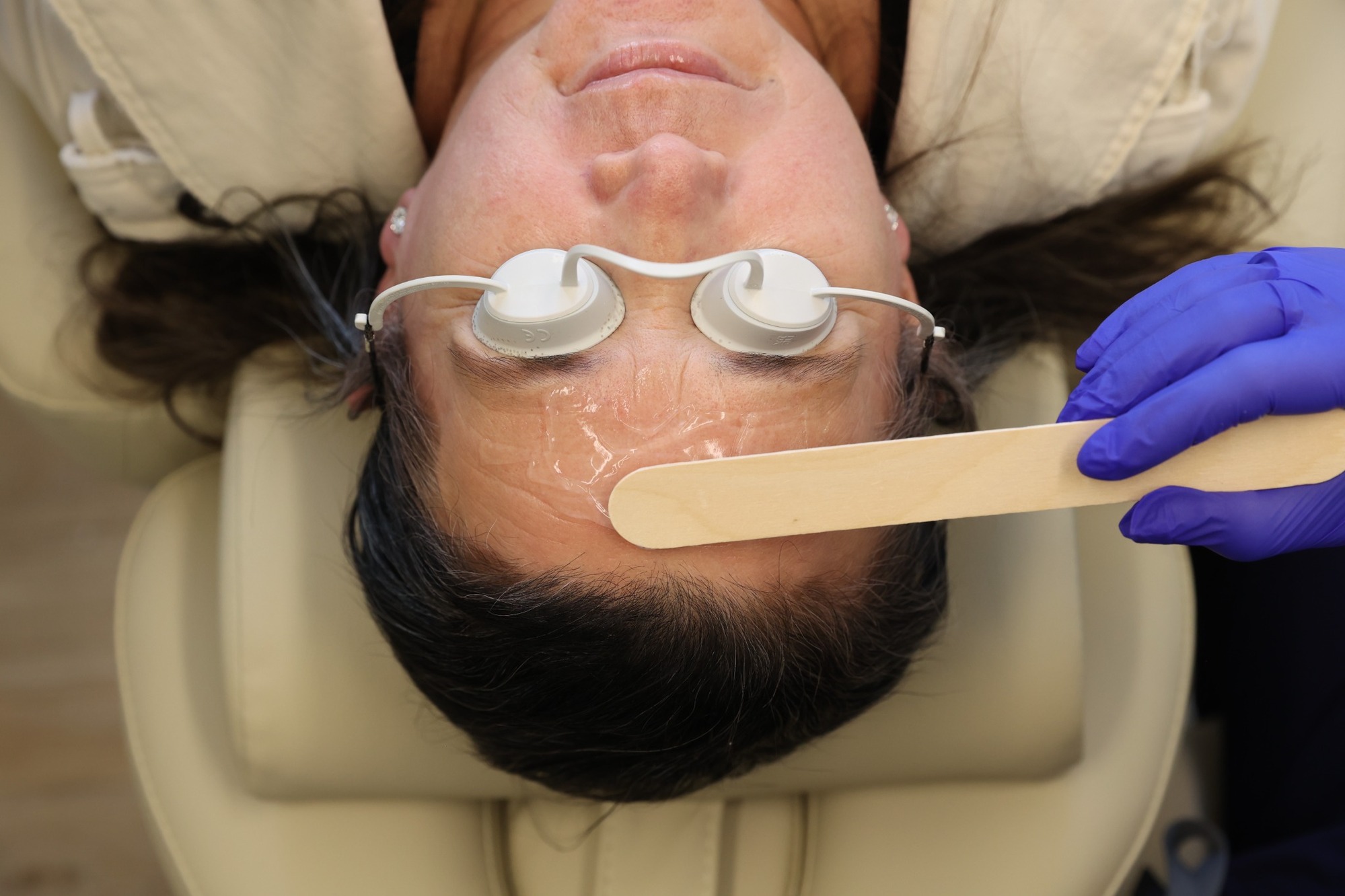 Patient receiving a chemical peel treatment as a skincare professional applies the solution to her forehead while she wears protective eye coverings.